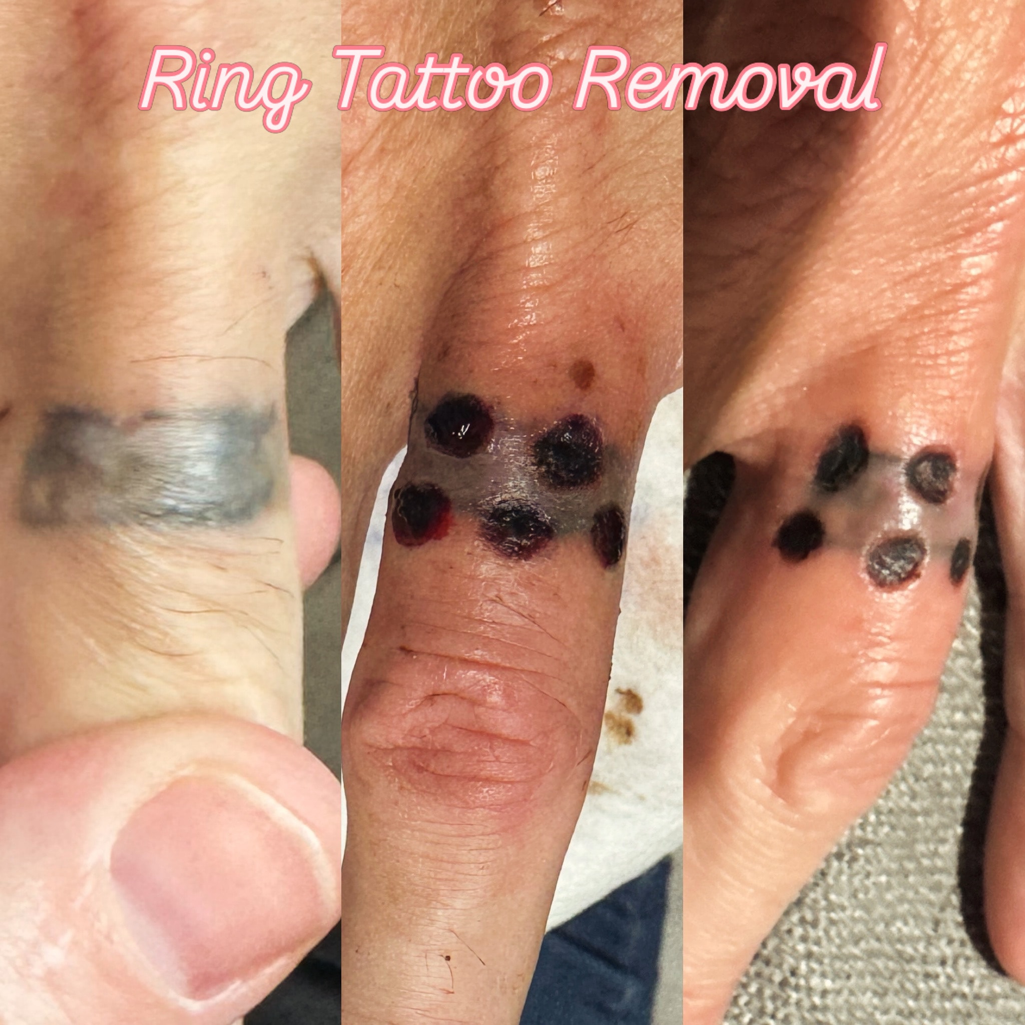 Ring tattoo removal — before, during treatment, and after multiple sessions.