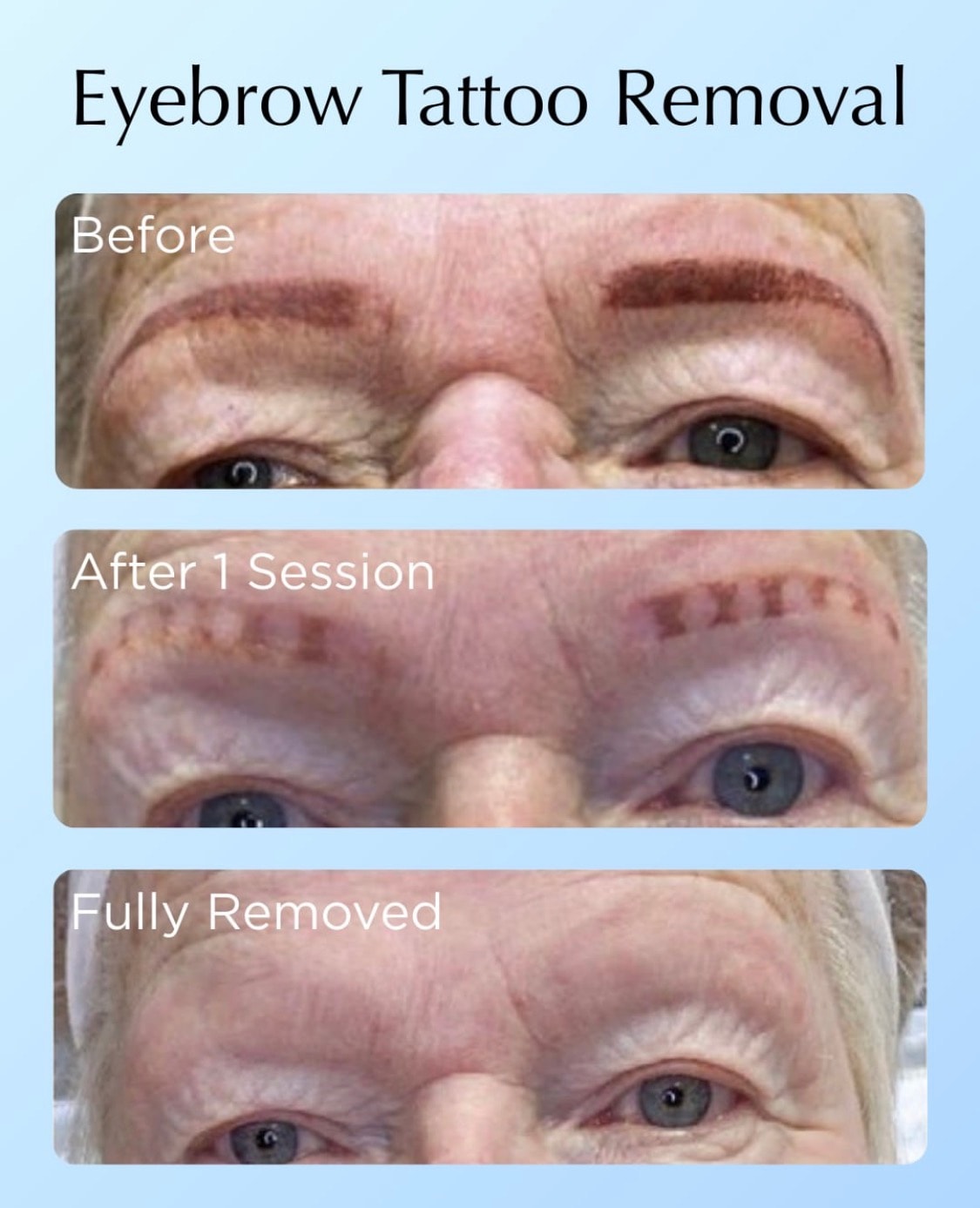 Eyebrow tattoo removal — before, after 1 session, and fully removed.