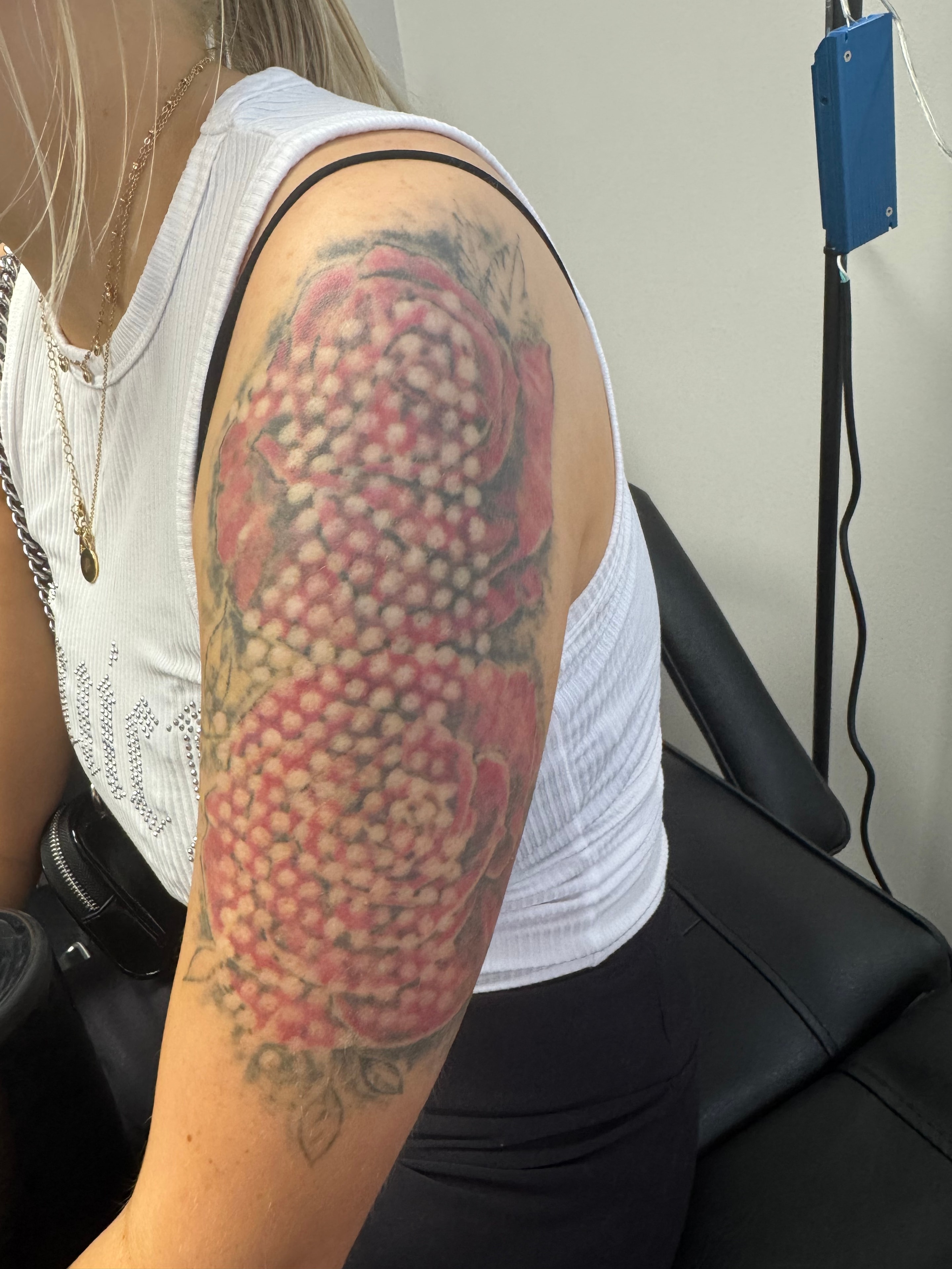 Color tattoo removal in progress — inkOUT works on every ink color.