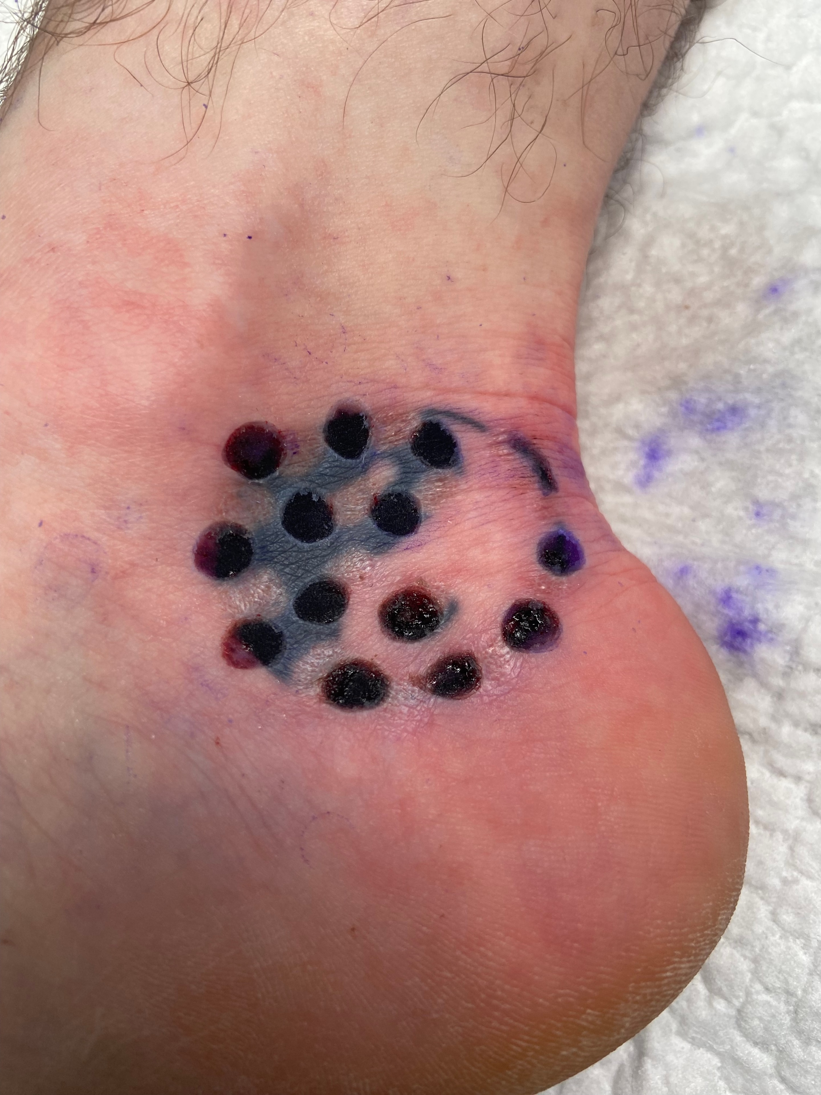 Tattoo removal treatment session — ink extraction in progress.