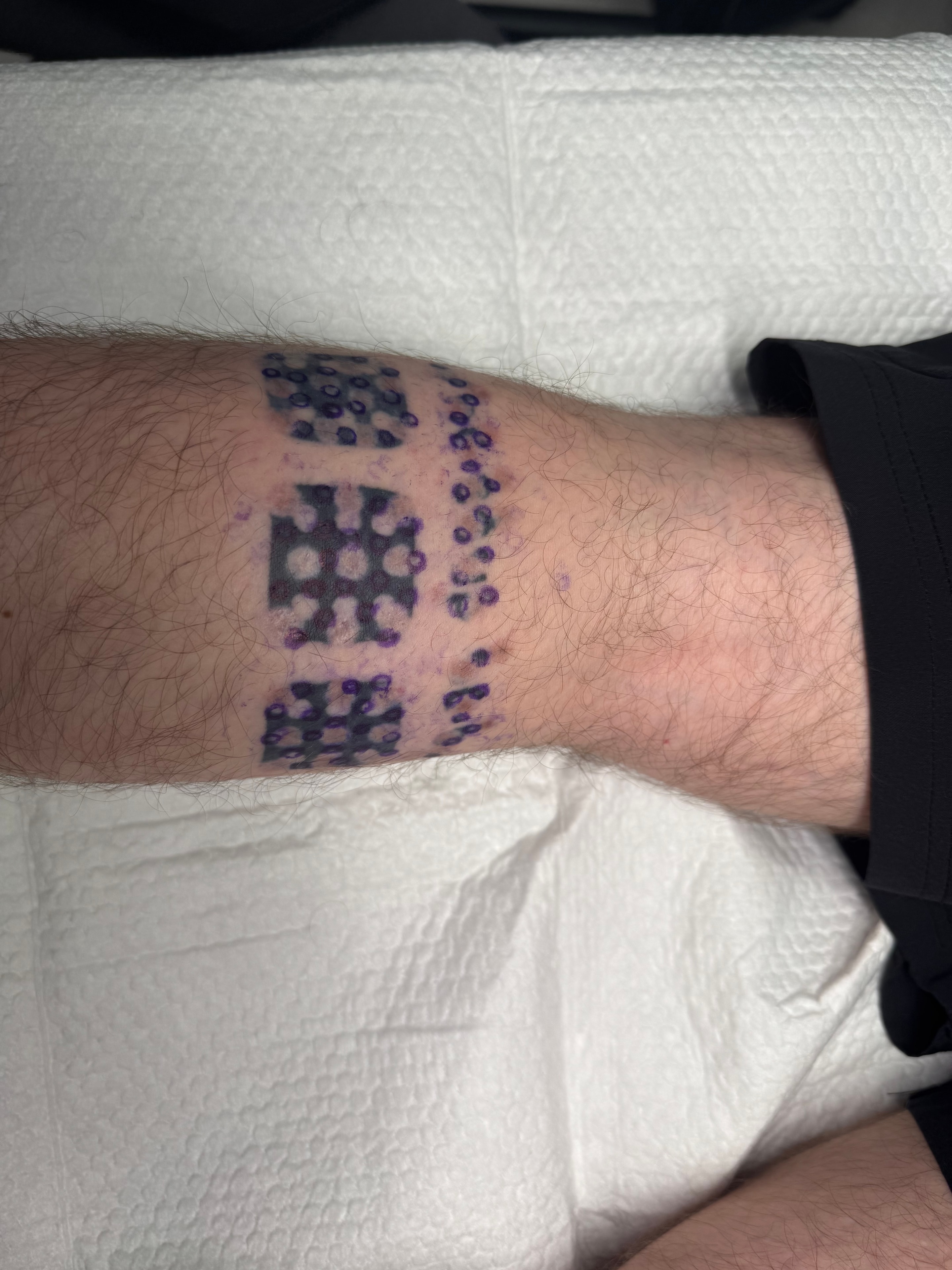 Tattoo removal in progress — visible ink gone after treatment.