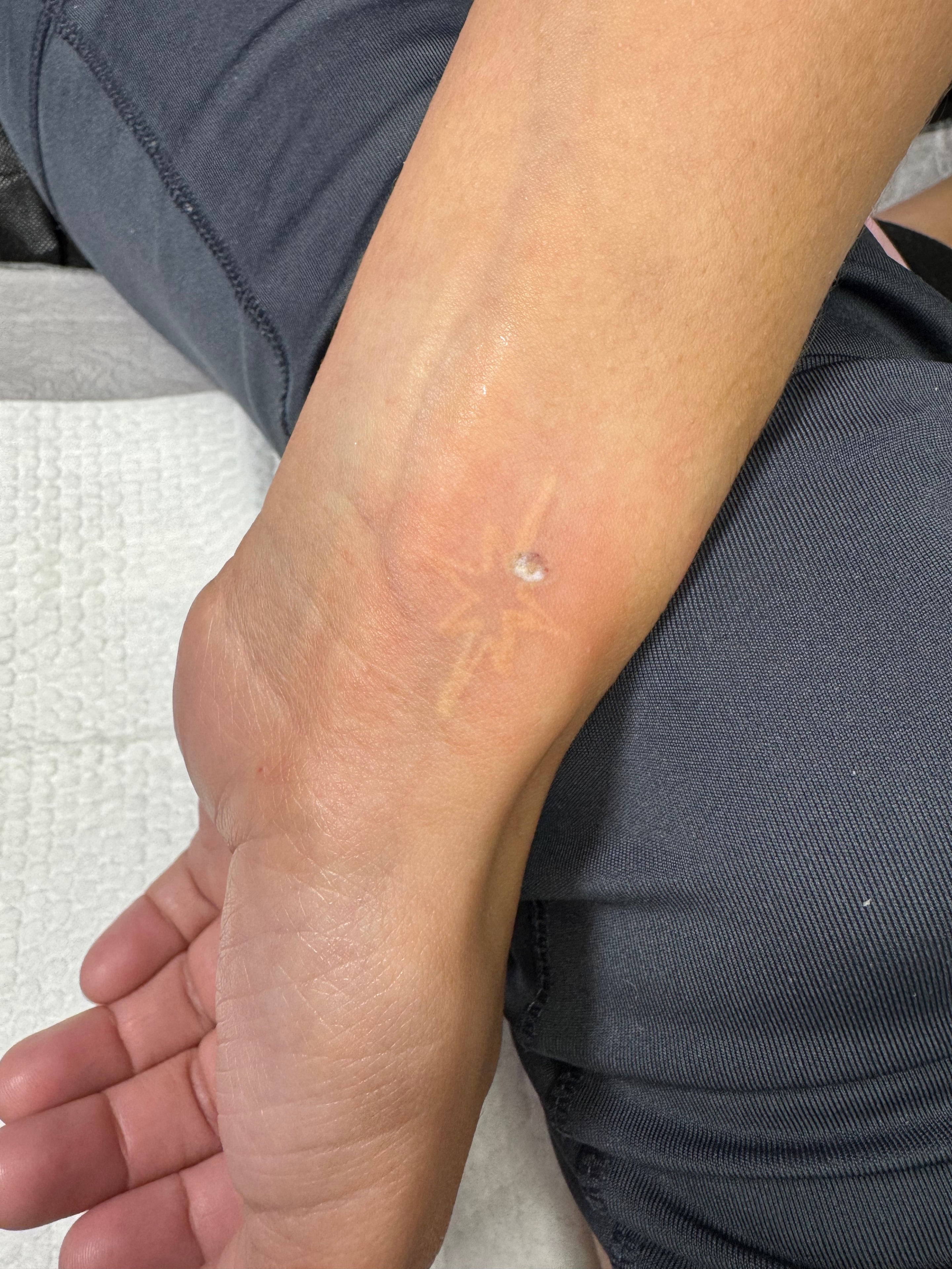 Right after a test spot — clean result, white ink will come out while it heals.