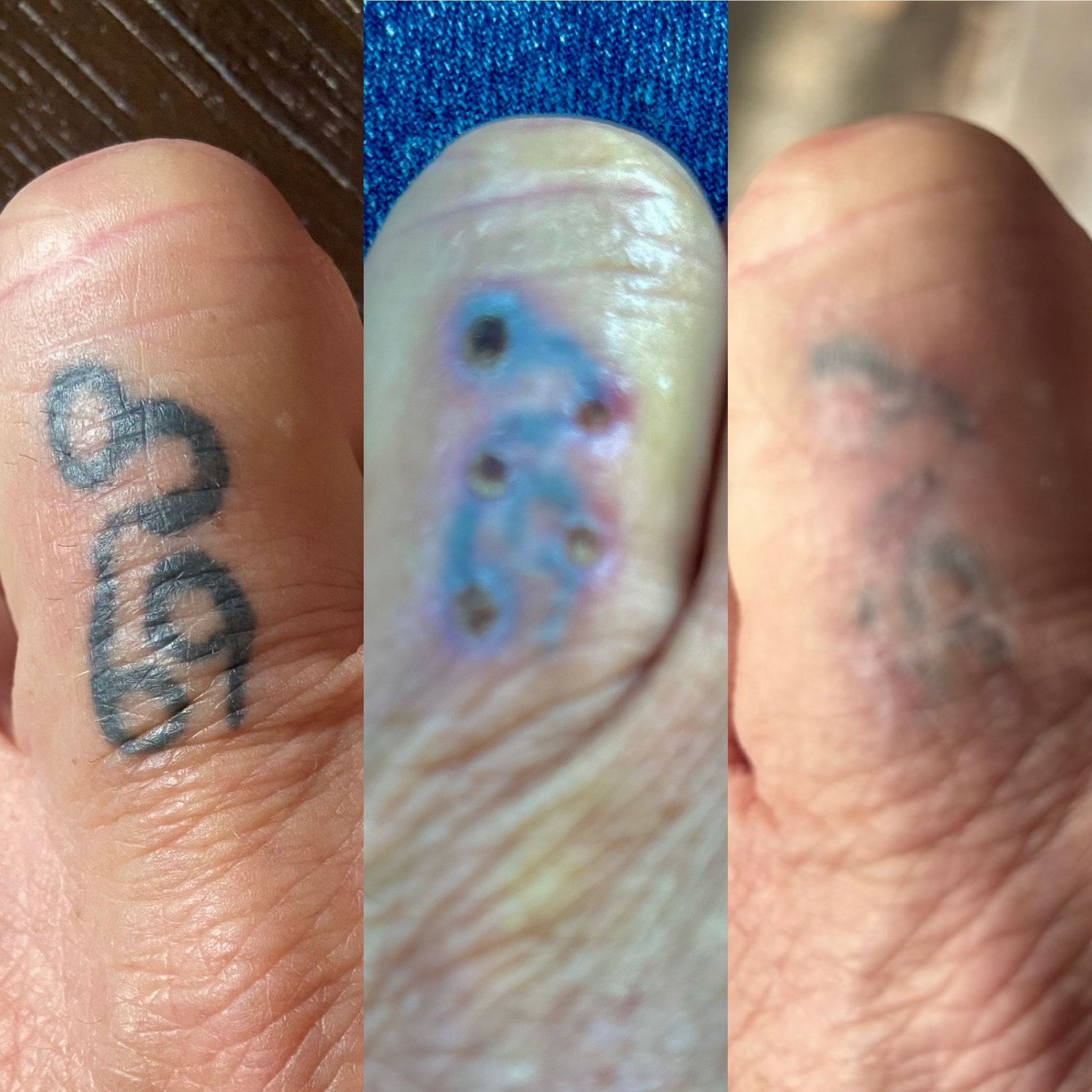 Before, during, and after tattoo removal — remarkable progress across sessions.