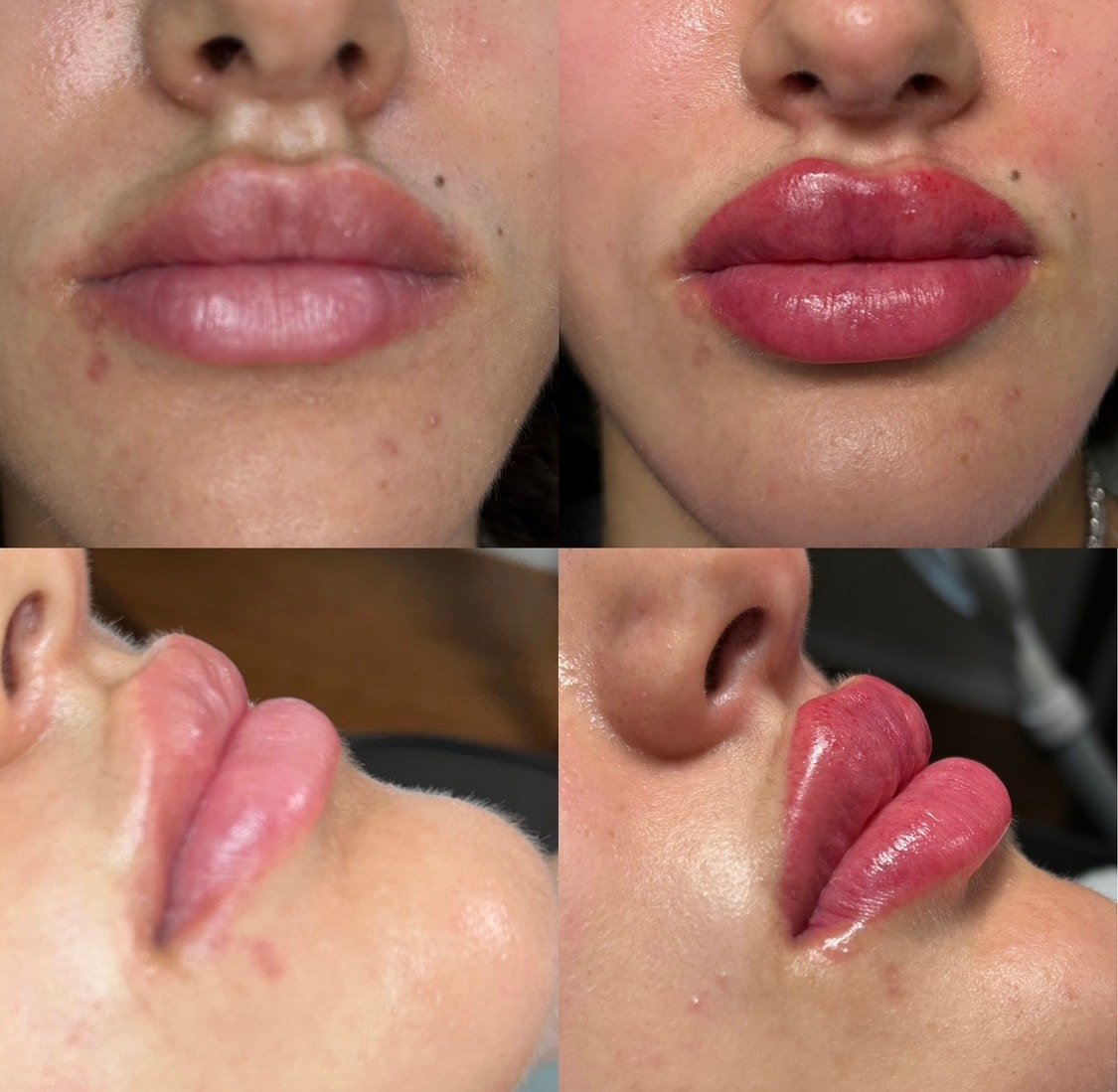 Lip Blush transformation result