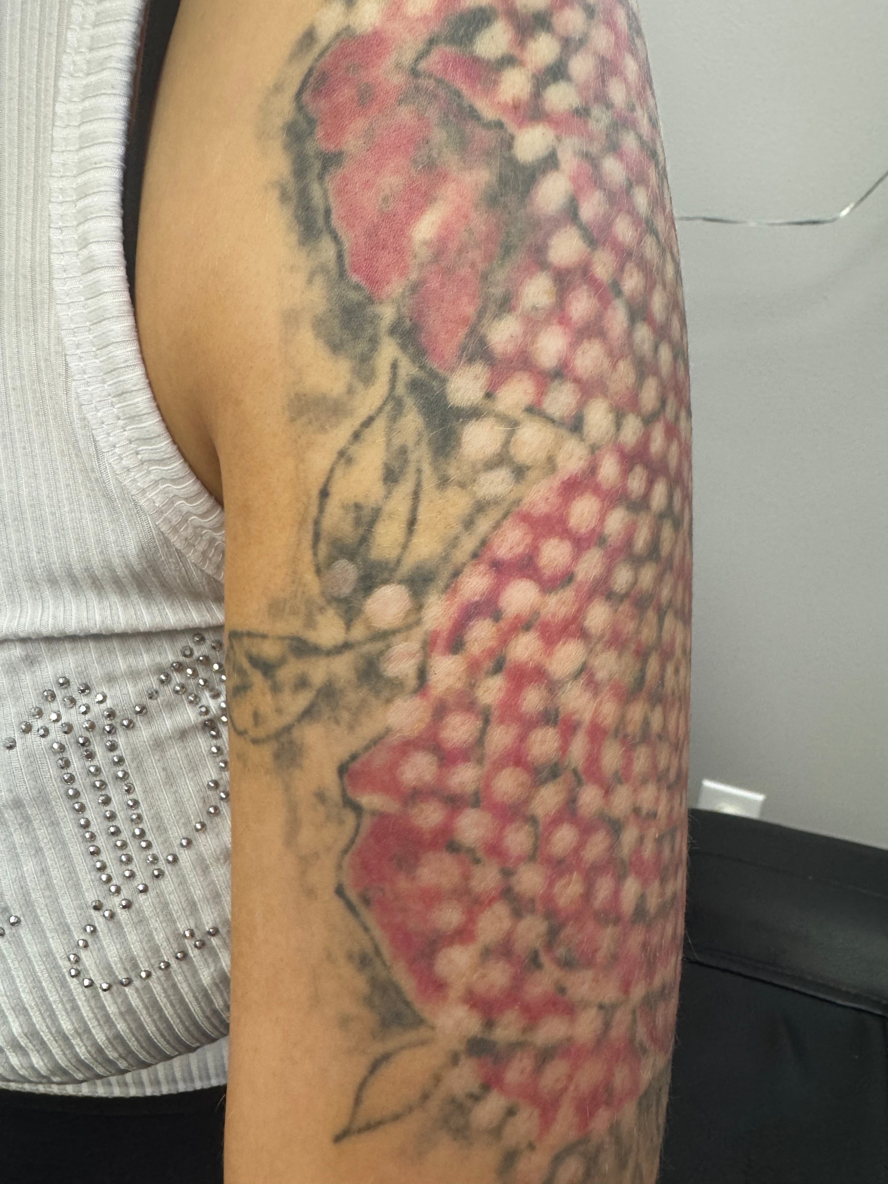 Non-laser tattoo removal treatment